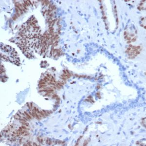 Formalin-fixed, paraffin-embedded human prostate tissue stained with ERG Recombinant Mouse Monoclonal Antibody (rERG/6843) at 2ug/ml. HIER: Tris/EDTA pH 9; 95°C/45min. 2°CAb: HRP-Polymer:30mins; DAB: 5min.