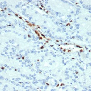 Formalin-fixed, paraffin-embedded human prostate tissue stained with ERG Recombinant Rabbit Monoclonal Antibody (ERG/22R) at 1ug/ml. HIER: Tris/EDTA pH 9; 95°C/45min. 2°CAb: HRP-Polymer:30mins; DAB:5min.