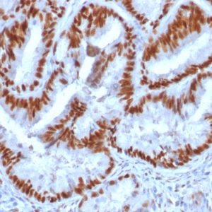 Formalin-fixed, paraffin-embedded human Endometrial Carcinoma stained with Estrogen Receptor alpha Mouse Monoclonal Antibody (1D5).