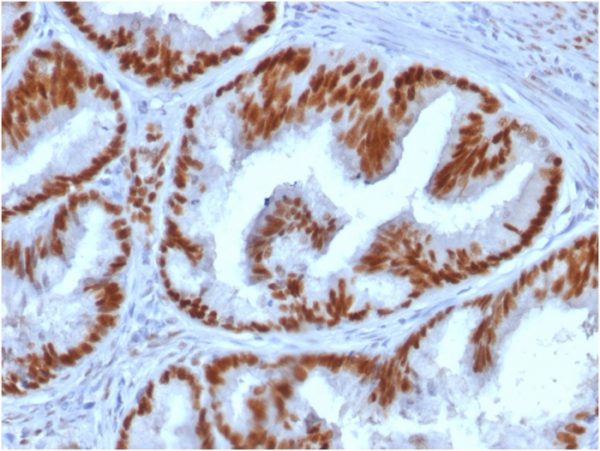 Formalin-fixed, paraffin-embedded human endometrial carcinoma stained with Estrogen Receptor alpha Mouse Monoclonal Antibody (ESR1/1935).