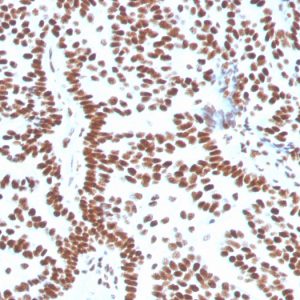 Formalin-fixed, paraffin-embedded human Breast Carcinoma stained with Estrogen Receptor alpha Mouse Monoclonal Antibody (ESR1/3556).