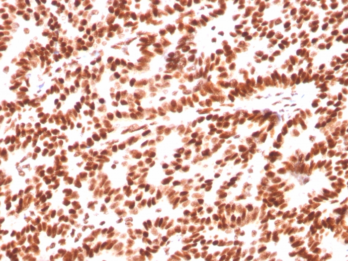 Formalin-fixed, paraffin-embedded human Breast Carcinoma stained with Estrogen Receptor alpha Mouse Monoclonal Antibody (ESR1/3559). Estrogen Receptor, alpha (Marker of Estrogen Dependence) Antibody - Image 2