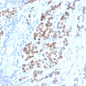 Formalin-fixed, paraffin-embedded human breast carcinoma stained with Estrogen Receptor alpha Mouse Monoclonal Antibody (ESR1/4008).
