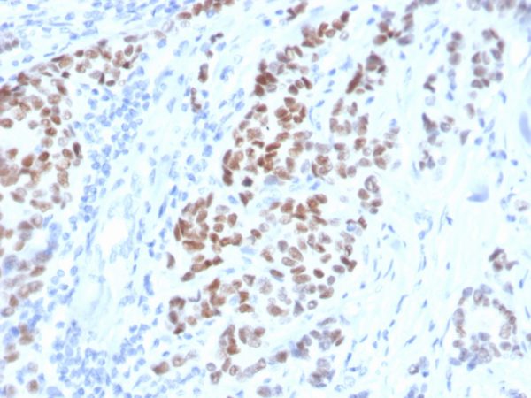 Formalin-fixed, paraffin-embedded human breast carcinoma stained with Estrogen Receptor alpha Mouse Monoclonal Antibody (ESR1/4008).
