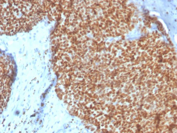 Formalin-fixed, paraffin-embedded human breast stained with Estrogen Receptor alpha Mouse Monoclonal Antibody (ESR1/4008).