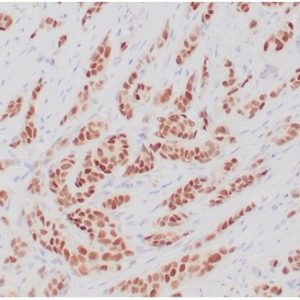 Formalin fixed paraffin embedded human breast carcinoma stained with ER, alpha Rabbit Recombinant Monoclonal Antibody(ESR1/4039R).
