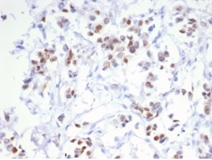 Formalin fixed paraffin embedded human breast carcinoma stained with ER, alpha Rabbit Recombinant Monoclonal Antibody (ESR1/6983R). HIER: Tris/EDTA, pH9.0, 45min. 2°C: HRP-polymer, 30min. DAB, 5min.