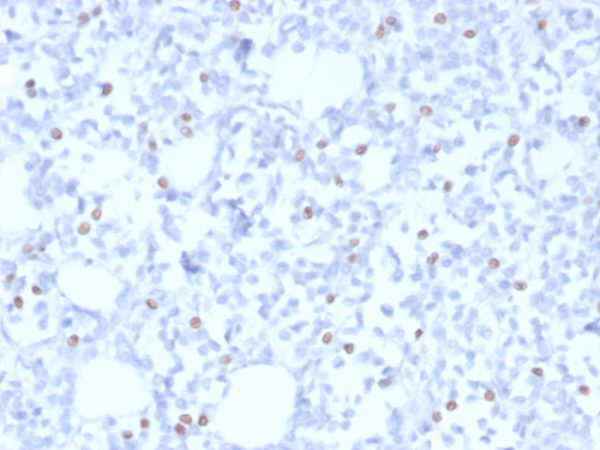 Formalin-fixed, paraffin-embedded human breast carcinoma stained with ER-beta1 Mouse Monoclonal Antibody (PPG5/10).