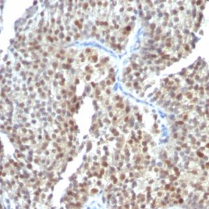 Formalin-fixed, paraffin-embedded human Bladder Carcinoma stained with ER-beta Mouse Monoclonal Antibody (ESR2/686).