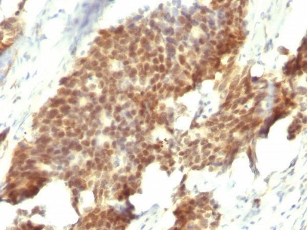 Formalin-fixed, paraffin-embedded human Gastric Carcinoma stained with ER-beta Mouse Monoclonal Antibody (ESR2/686).