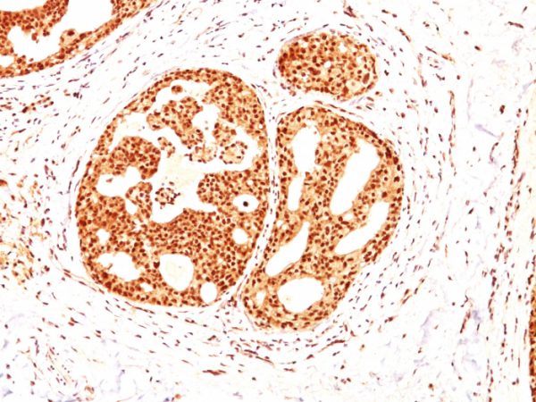 Formalin-fixed, paraffin-embedded human Breast Carcinoma stained with ER-beta Mouse Monoclonal Antibody (ESR2/686).