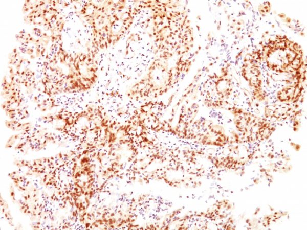 Formalin-fixed, paraffin-embedded human Ovarian Carcinoma stained with ER-beta Mouse Monoclonal Antibody (ESR2/686).