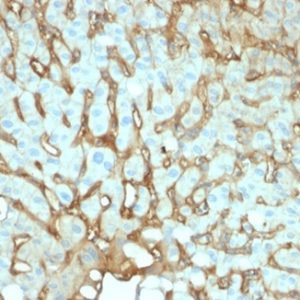 Formalin-fixed, paraffin-embedded human hepatocellular carcinoma stained with Albumin Mouse Monoclonal Antibody (ALB/2141).