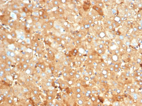 Formalin-fixed, paraffin-embedded human liver carcinoma in colon stained with Albumin Recombinant Mouse Monoclonal Antibody (rALB/6412).