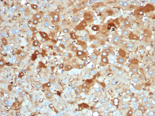 Formalin-fixed, paraffin-embedded human liver carcinoma in colon stained with Albumin Recombinant Mouse Monoclonal Antibody (rALB/6414).