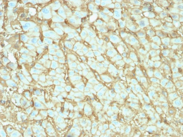 Formalin-fixed, paraffin-embedded human Hepatocellular Carcinoma stained with Albumin-Monospecific Mouse Monoclonal Antibody (ALB/2142).