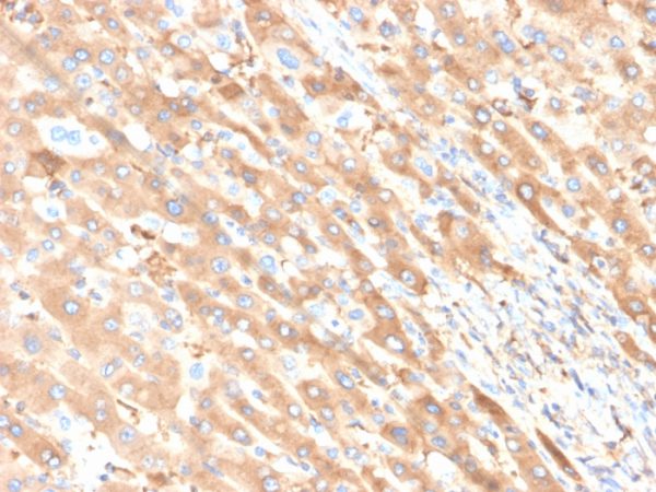 Formalin-fixed, paraffin-embedded human liver carcinoma in colon stained with Albumin Recombinant Rabbit Monoclonal Antibody (ALB/6411R).