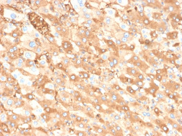 Formalin-fixed, paraffin-embedded human liver carcinoma in colon stained with Albumin Recombinant Rabbit Monoclonal Antibody (ALB/6413R).