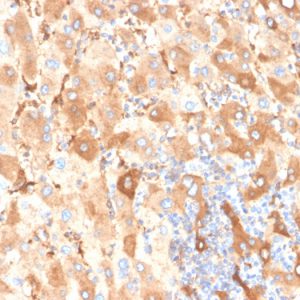 Formalin-fixed, paraffin-embedded human liver carcinoma in colon stained with Albumin Recombinant Rabbit Monoclonal Antibody (ALB/6409R).