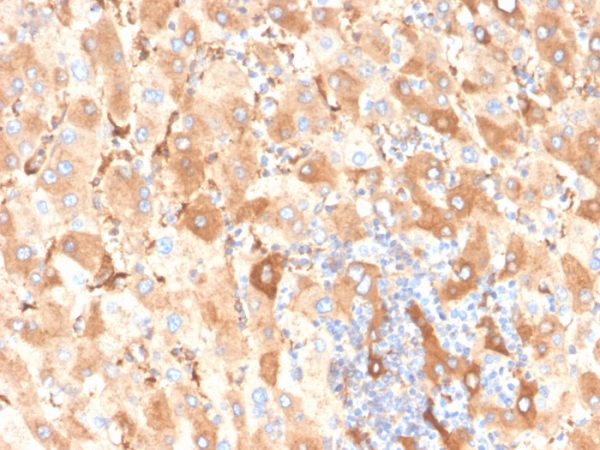 Formalin-fixed, paraffin-embedded human liver carcinoma in colon stained with Albumin Recombinant Rabbit Monoclonal Antibody (ALB/6409R).