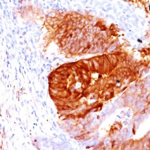 Formalin-fixed, paraffin-embedded human Colon Carcinoma stained with ALDH1A1 Mouse Monoclonal Antibody (ALDH1A1/1381).