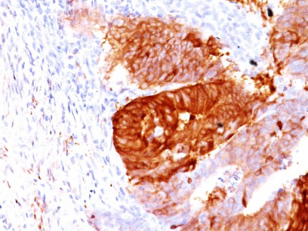 Formalin-fixed, paraffin-embedded human Colon Carcinoma stained with ALDH1A1 Mouse Monoclonal Antibody (ALDH1A1/1381).