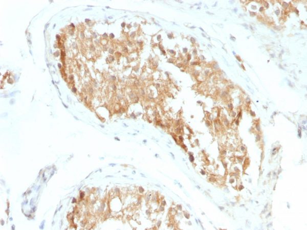 Formalin-fixed, paraffin-embedded human Testicular Carcinoma stained with ALDH1A1 Mouse Monoclonal Antibody (ALDH1A1/1381).