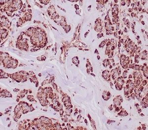 Formalin-fixed, paraffin-embedded human breast carcinoma in tonsil stained with ALDH1A1 Mouse Monoclonal Antibody (ALDH1A1/4793) at 2ug/ml. HIER: Tris/EDTA, pH9.0, 45min. 2 °: HRP-polymer, 30min. DAB, 5min.