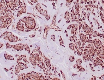 Formalin-fixed, paraffin-embedded human breast carcinoma in tonsil stained with ALDH1A1 Mouse Monoclonal Antibody (ALDH1A1/4793) at 2ug/ml. HIER: Tris/EDTA, pH9.0, 45min. 2 °: HRP-polymer, 30min. DAB, 5min.