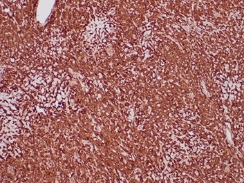 Formalin-fixed, paraffin-embedded human sarcoma in tonsil stained with ALDH1A1 Mouse Monoclonal Antibody (ALDH1A1/4793) at 2ug/ml. HIER: Tris/EDTA, pH9.0, 45min. 2 °: HRP-polymer, 30min. DAB, 5min.