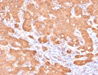 Formalin-fixed, paraffin-embedded human colon carcinoma in tonsil stained with ALDH1A1 Mouse Monoclonal Antibody (ALDH1A1/4793).