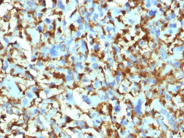 Formalin-fixed, paraffin-embedded human Histiocytoma stained with Factor XIIIa Mouse Monoclonal Antibody (F13A1/1448).