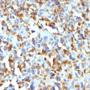 Formalin-fixed, paraffin-embedded human Histiocytoma stained with Factor XIIIa Mouse Monoclonal Antibody (F13A1/1683).