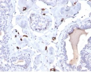 Formalin-fixed, paraffin-embedded human breast carcinoma stained with FABP4 Mouse Monoclonal Antibody (FABP4/4422).