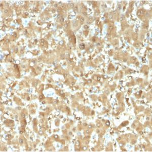 Formalin-fixed, paraffin-embedded human Liver Carcinoma stained with FABP1 Mouse Monoclonal Antibody (FABP1/3482).