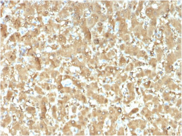 Formalin-fixed, paraffin-embedded human Liver Carcinoma stained with FABP1 Mouse Monoclonal Antibody (FABP1/3482).