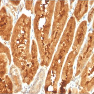 Formalin-fixed, paraffin-embedded human liver carcinoma stained with FABP1 Mouse Monoclonal Antibody (FABP1/3487).