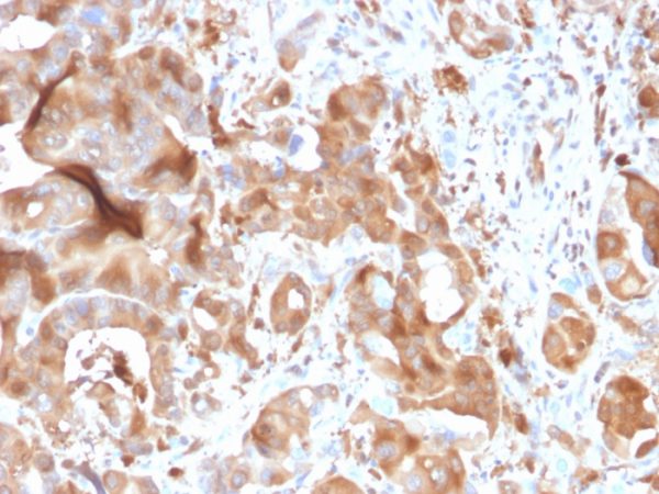 Formalin-fixed, paraffin-embedded human hepatic carcinoma stained with FABP5 Mouse Monoclonal Antibody (CPTC-FABP5-3).