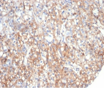 Formalin-fixed, paraffin-embedded human kidney carcinoma stained with Fibrillin 1 Mouse Monoclonal Antibody (FBN1/6933). HIER: Tris/EDTA, pH9.0, 45min. 2 °: HRP-polymer, 30min. DAB, 5min.
