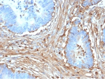 Formalin-fixed, paraffin-embedded human colon carcinoma stained with Fibrillin 1 Mouse Monoclonal Antibody (FBN1/6933). HIER: Tris/EDTA, pH9.0, 45min. 2°C: HRP-polymer, 30min. DAB, 5min.