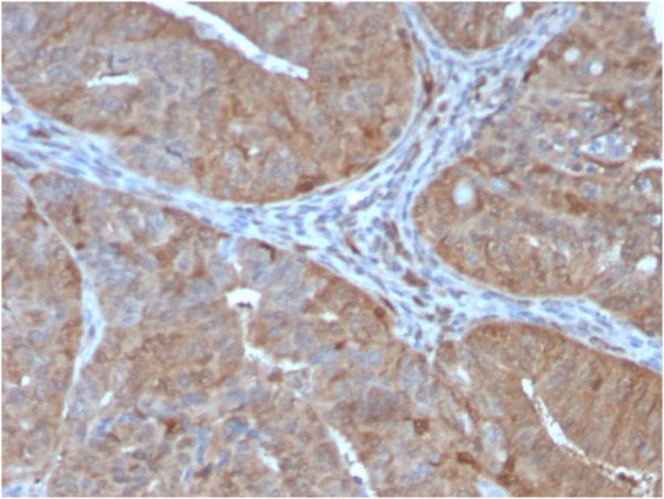 Formalin-fixed, paraffin-embedded human prostate stained with AKR1B1 Mouse Monoclonal Antibody (CPTC-AKR1B1-2).