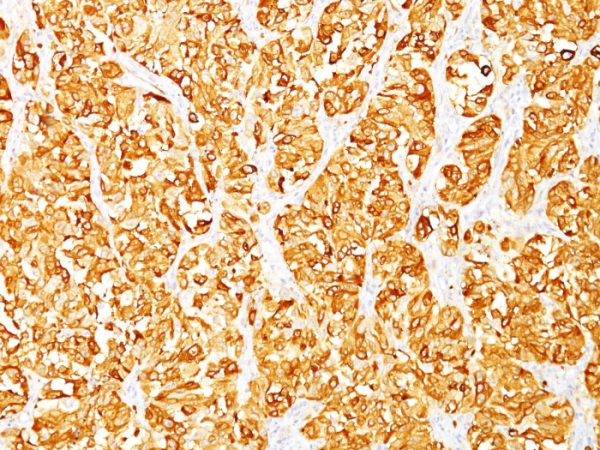Formalin-fixed, paraffin-embedded human Melanoma stained with MART-1 Monoclonal Antibody (M2-7C10).