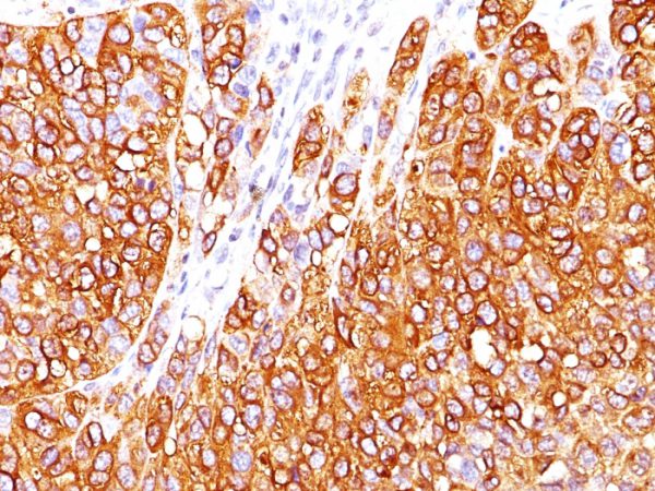 Formalin-fixed, paraffin-embedded human Melanoma stained with MART-1 Monoclonal Antibody (M2-7C10).