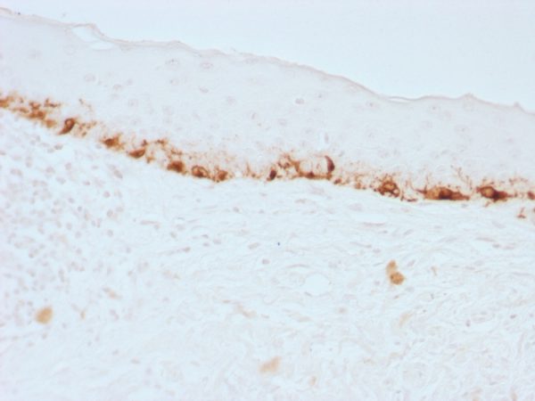 Formalin-fixed, paraffin-embedded human Skin stained with MART-1 Monoclonal Antibody (M2-7C10).