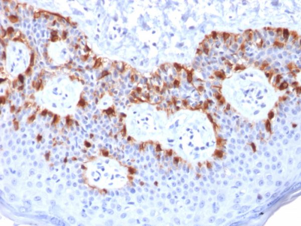 Formalin-fixed, paraffin-embedded human Melanoma stained with MART-1 Mouse Recombinant Monoclonal Antibody (rMLANA/788).