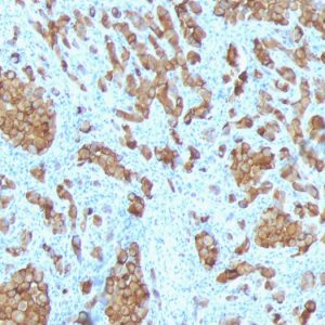 Formalin-fixed, paraffin-embedded human Melanoma stained with MART-1 Ab (SPM342).