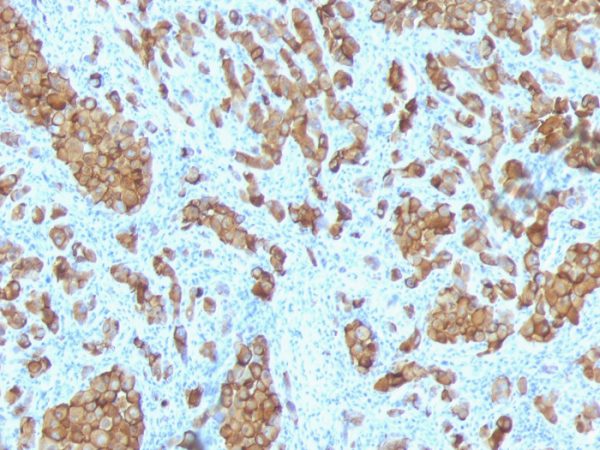 Formalin-fixed, paraffin-embedded human Melanoma stained with MART-1 Ab (SPM342).