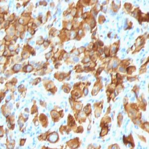 Formalin-fixed, paraffin-embedded human Melanoma stained with Melan-A Monoclonal Antibody (SPM540).