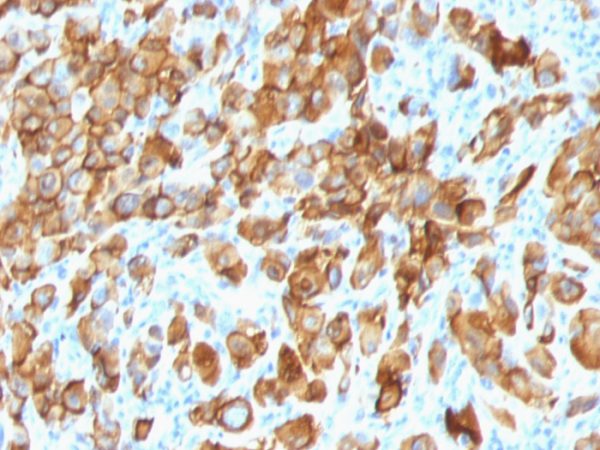 Formalin-fixed, paraffin-embedded human Melanoma stained with Melan-A Monoclonal Antibody (SPM540).