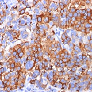 Formalin-fixed, paraffin-embedded human Melanoma stained with MART-1 / Melan-A Mouse Monoclonal Antibody (A103).